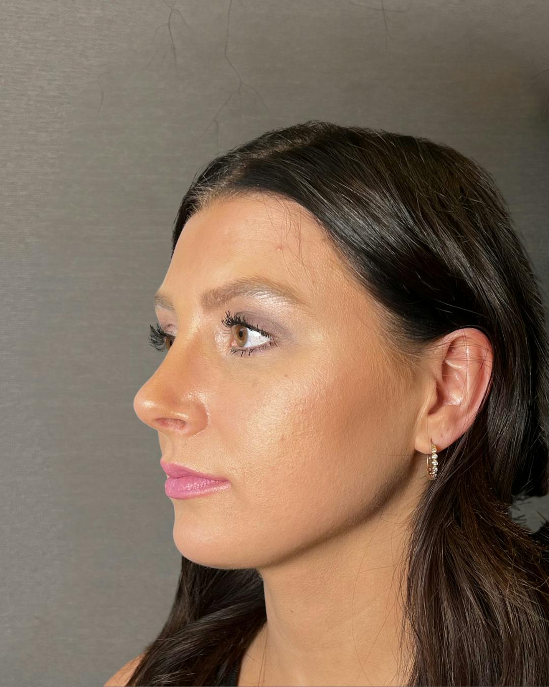 Rhinoplasty Before & After Gallery - Patient 191294715 - Image 6