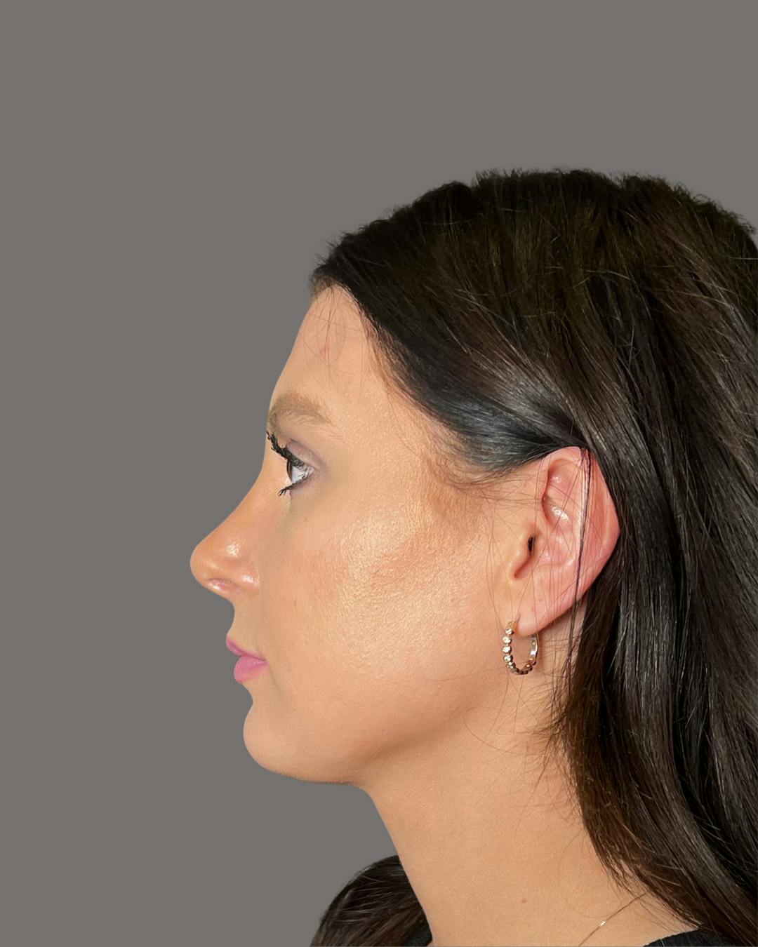 Rhinoplasty Before & After Gallery - Patient 191294715 - Image 8