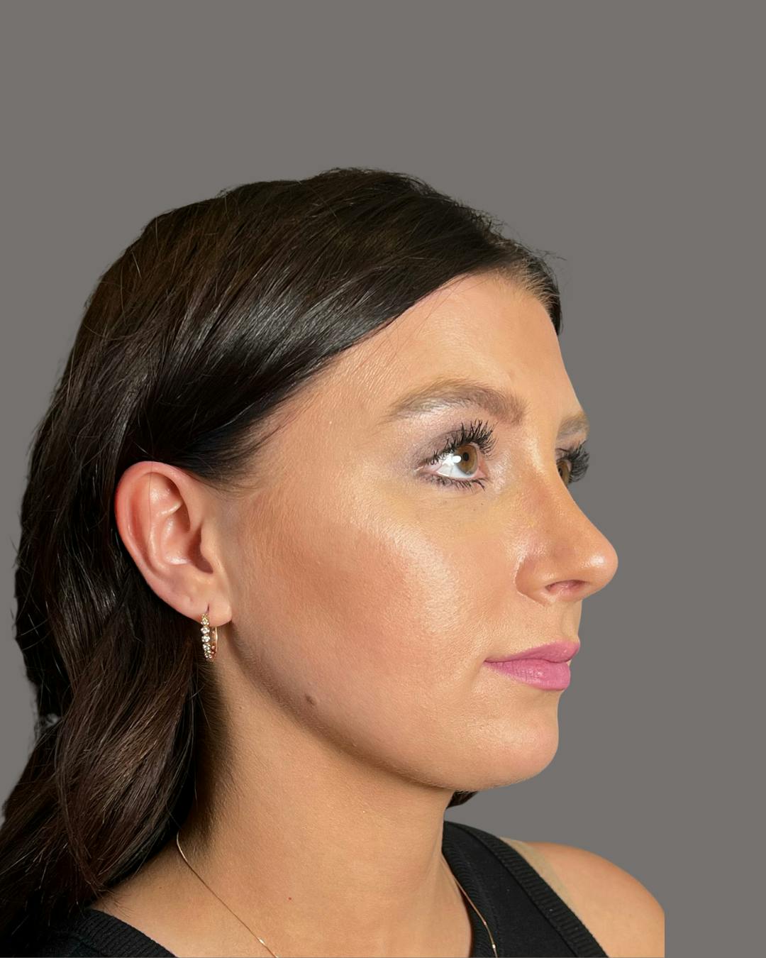 Rhinoplasty Before & After Gallery - Patient 191294715 - Image 2