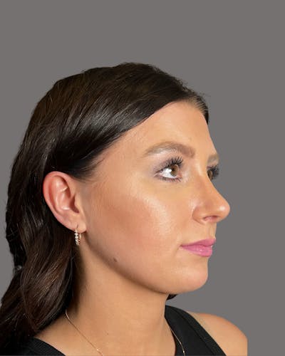 Rhinoplasty Before & After Gallery - Patient 191294715 - Image 2