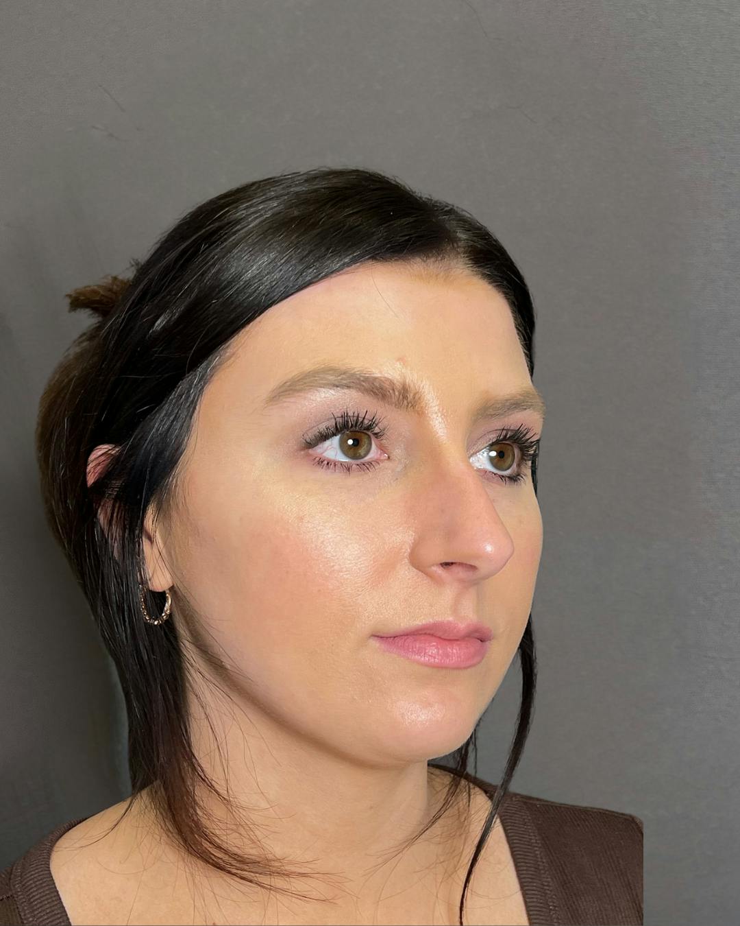 Rhinoplasty Before & After Gallery - Patient 191294715 - Image 3