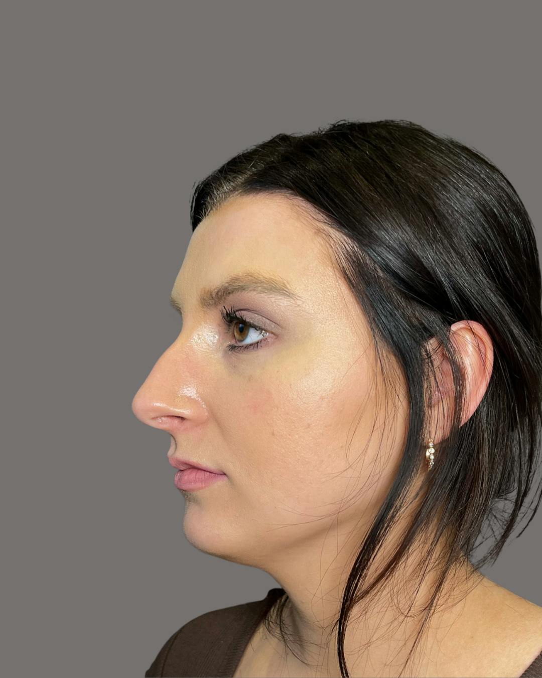 Rhinoplasty Before & After Gallery - Patient 191294715 - Image 5