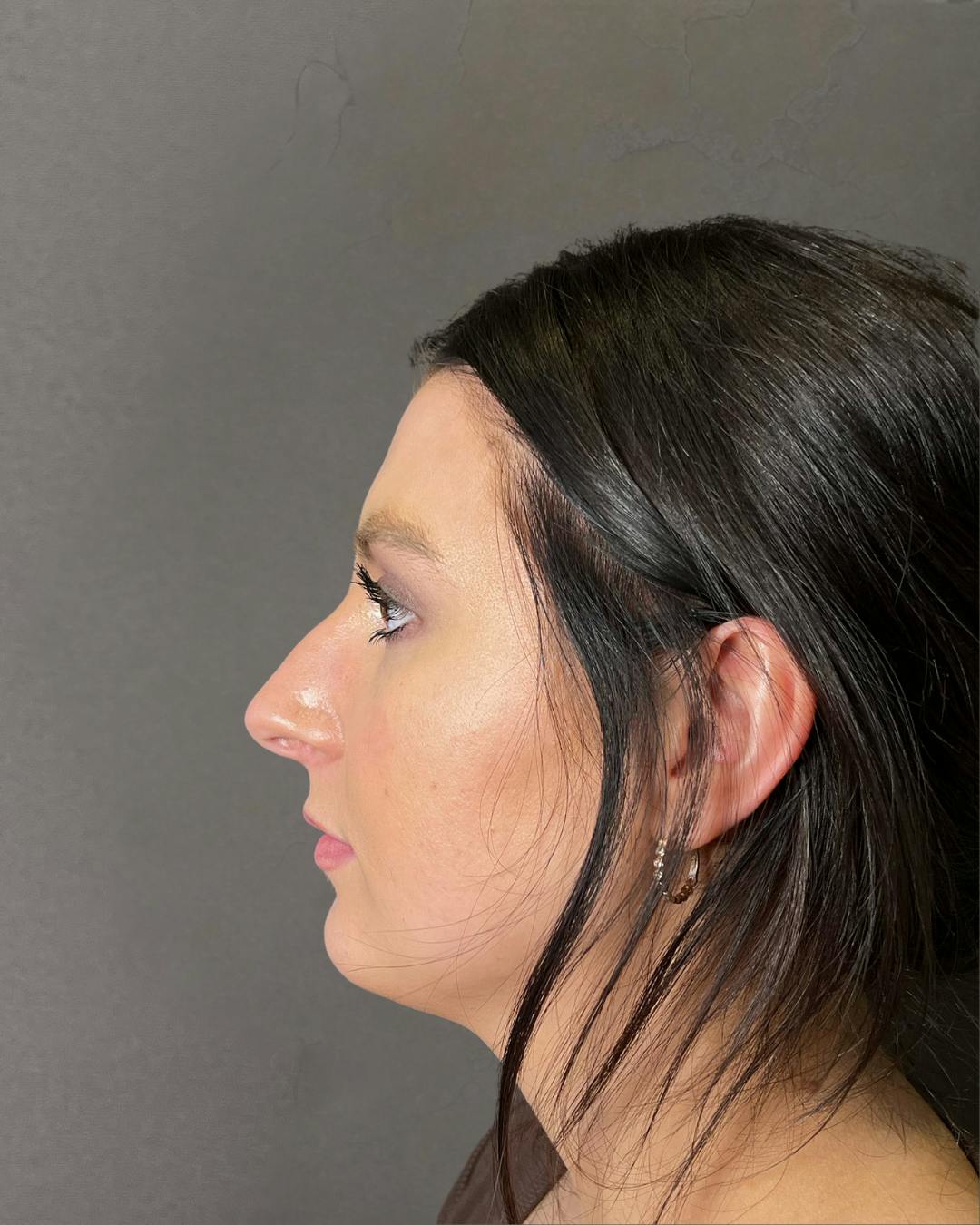 Rhinoplasty Before & After Gallery - Patient 191294715 - Image 7
