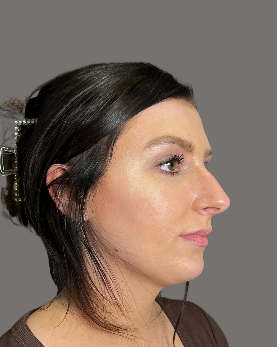 Rhinoplasty Before & After Gallery - Patient 191294715 - Image 1