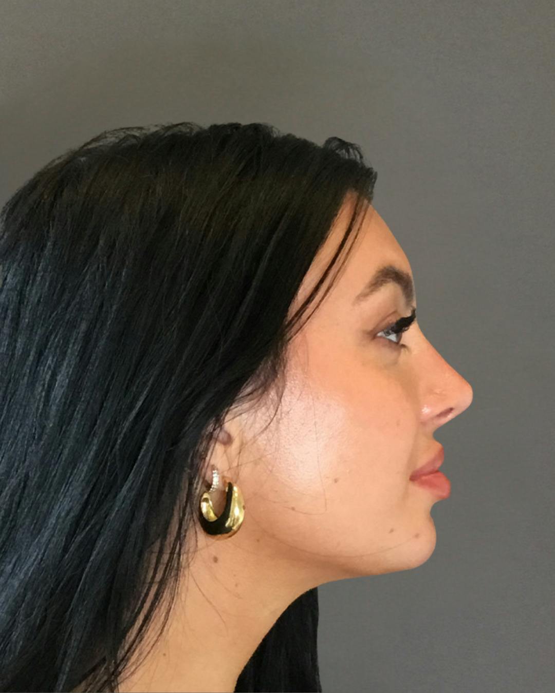 Rhinoplasty Before & After Gallery - Patient 390758 - Image 2
