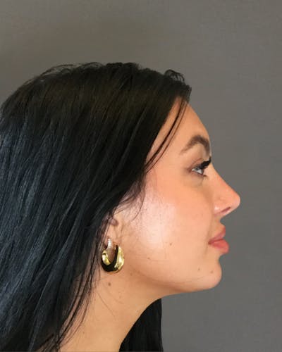Rhinoplasty Before & After Gallery - Patient 390758 - Image 2