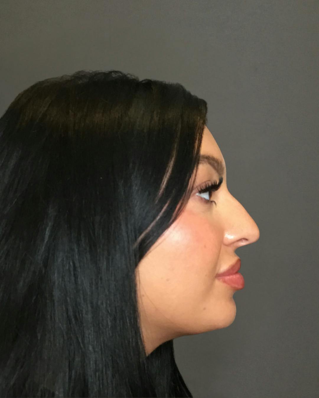 Rhinoplasty Before & After Gallery - Patient 390758 - Image 1