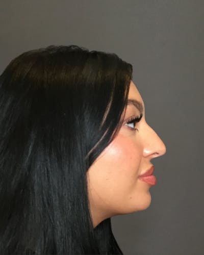 Rhinoplasty Before & After Gallery - Patient 390758 - Image 1
