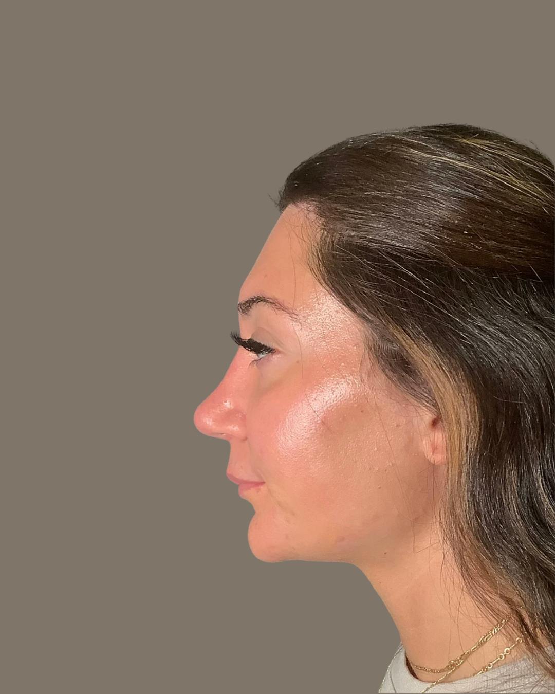 Rhinoplasty Before & After Gallery - Patient 140797 - Image 8