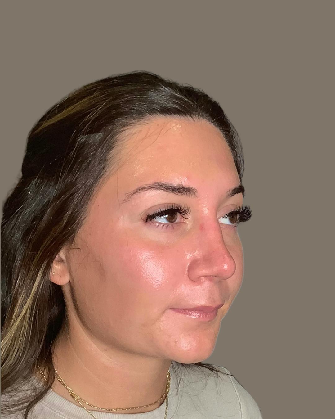 Rhinoplasty Before & After Gallery - Patient 140797 - Image 4