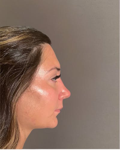 Rhinoplasty Before & After Gallery - Patient 140797 - Image 2