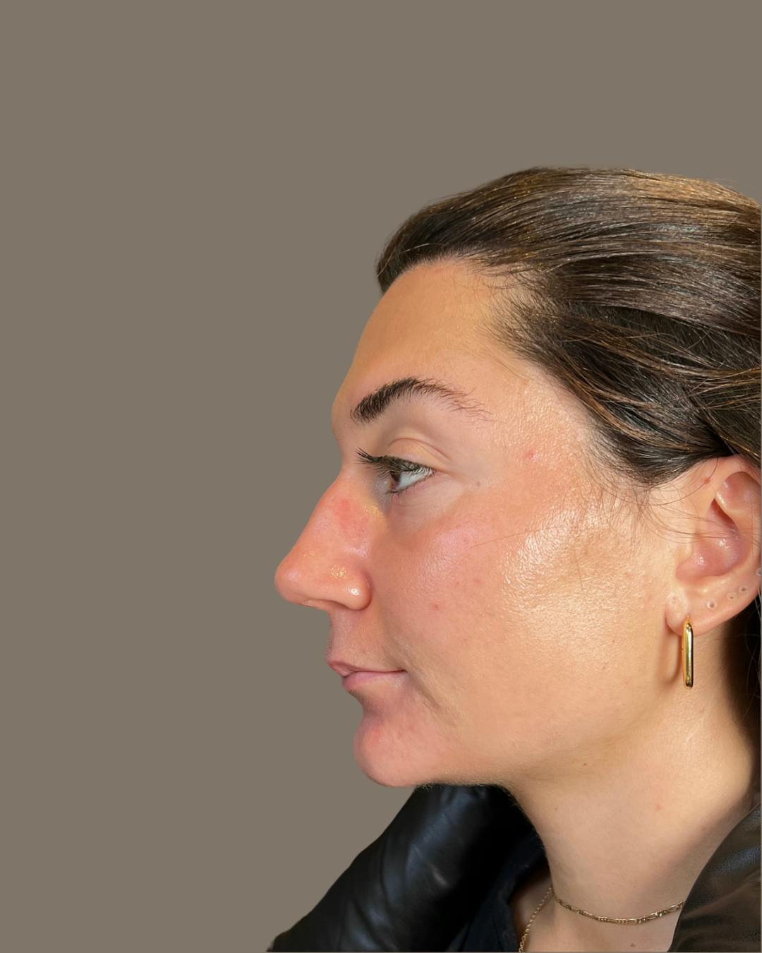 Rhinoplasty Before & After Gallery - Patient 140797 - Image 7