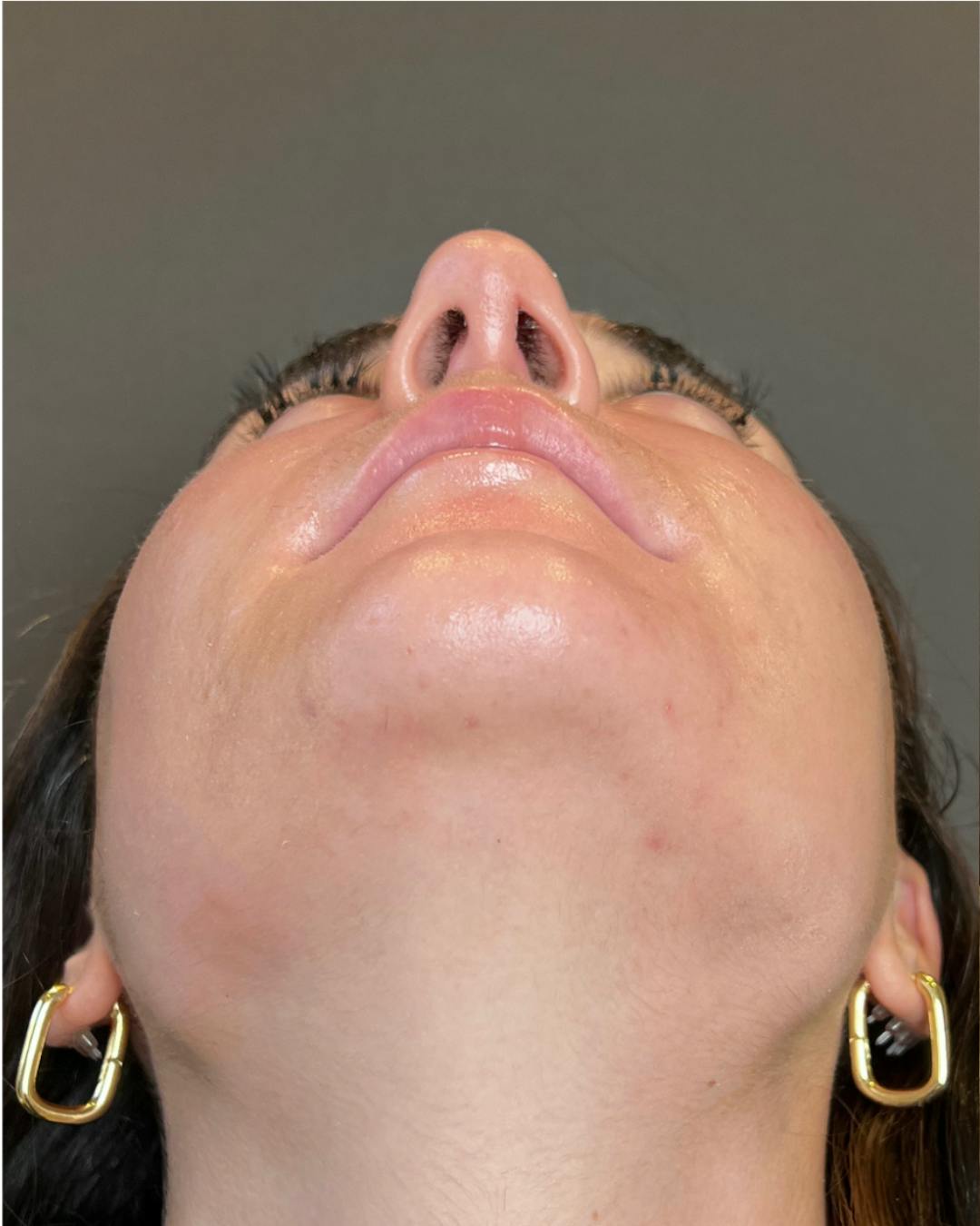 Rhinoplasty Before & After Gallery - Patient 140797 - Image 9