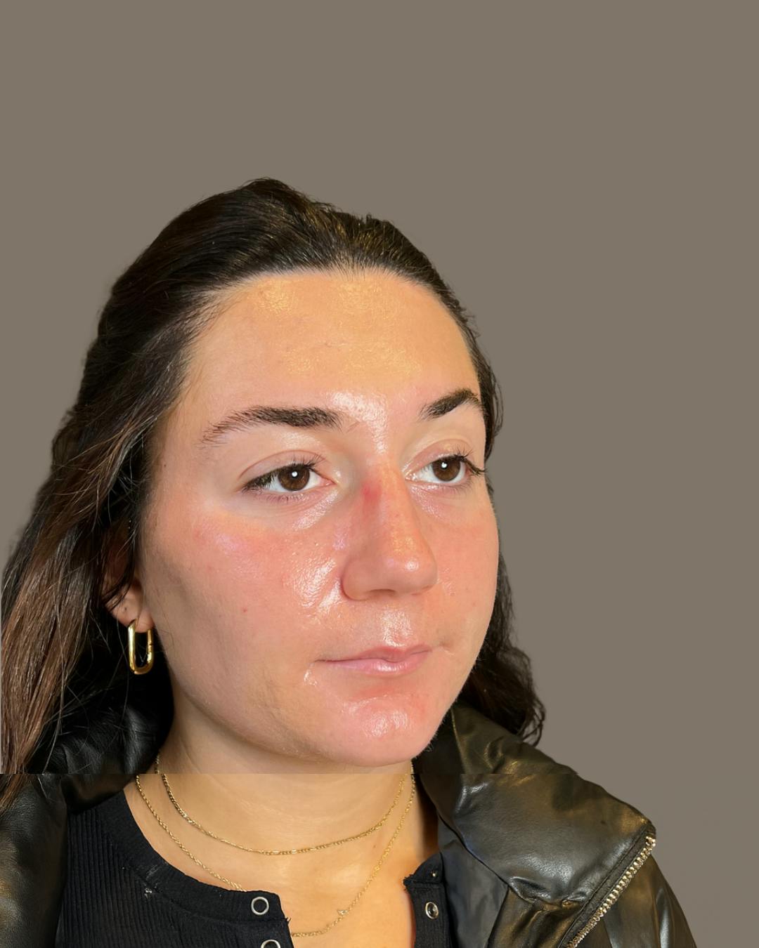 Rhinoplasty Before & After Gallery - Patient 140797 - Image 3