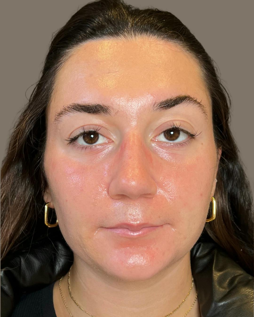 Rhinoplasty Before & After Gallery - Patient 140797 - Image 5