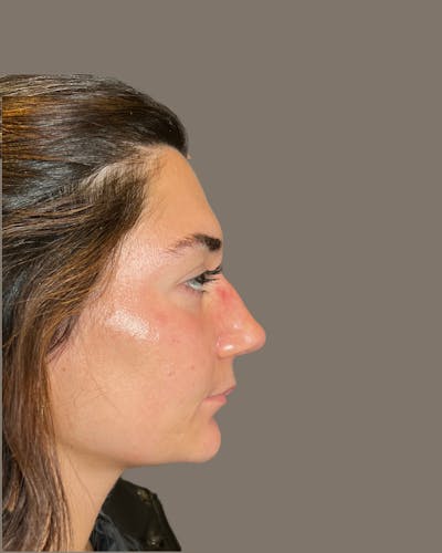 Rhinoplasty Before & After Gallery - Patient 140797 - Image 1