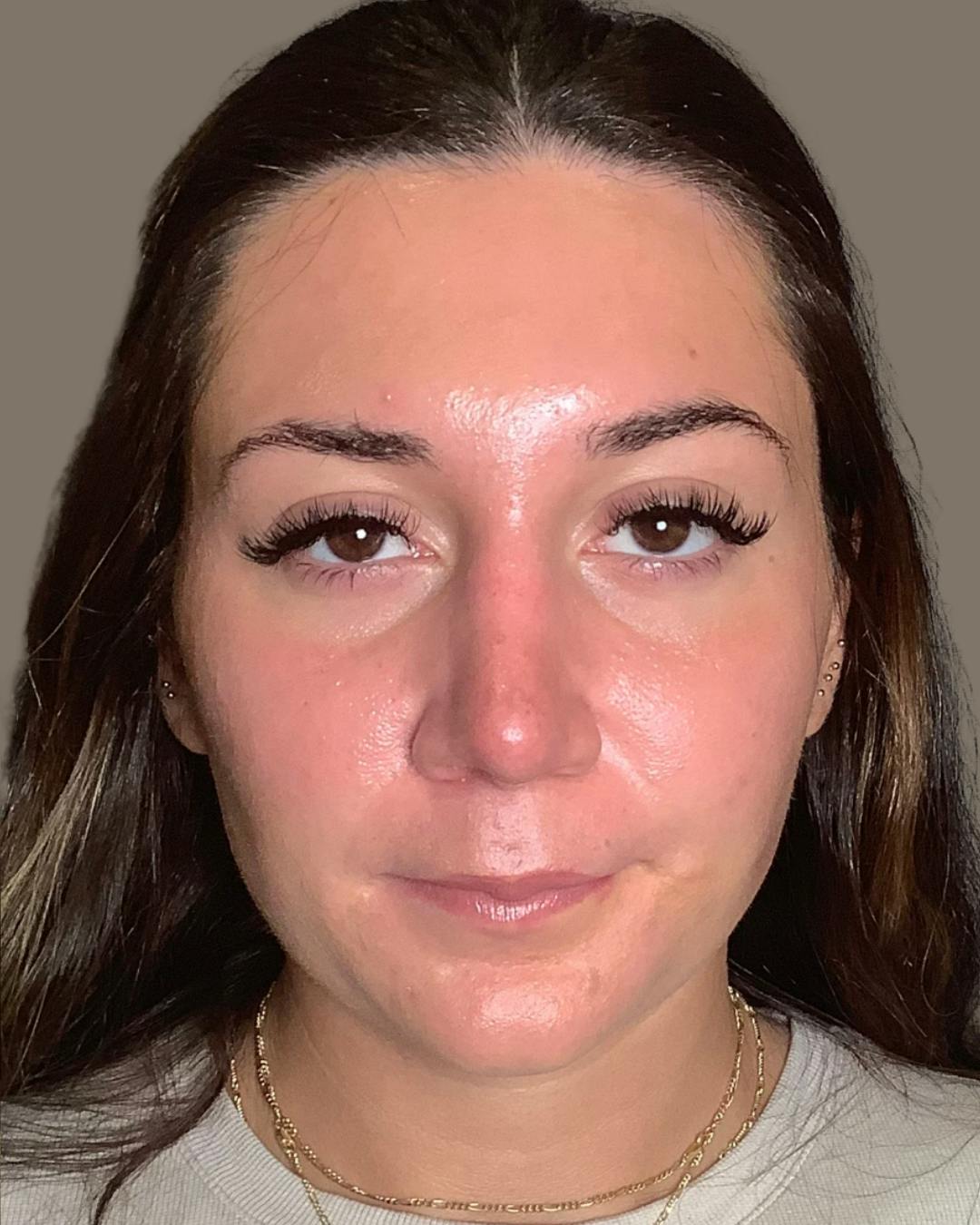 Rhinoplasty Before & After Gallery - Patient 140797 - Image 6
