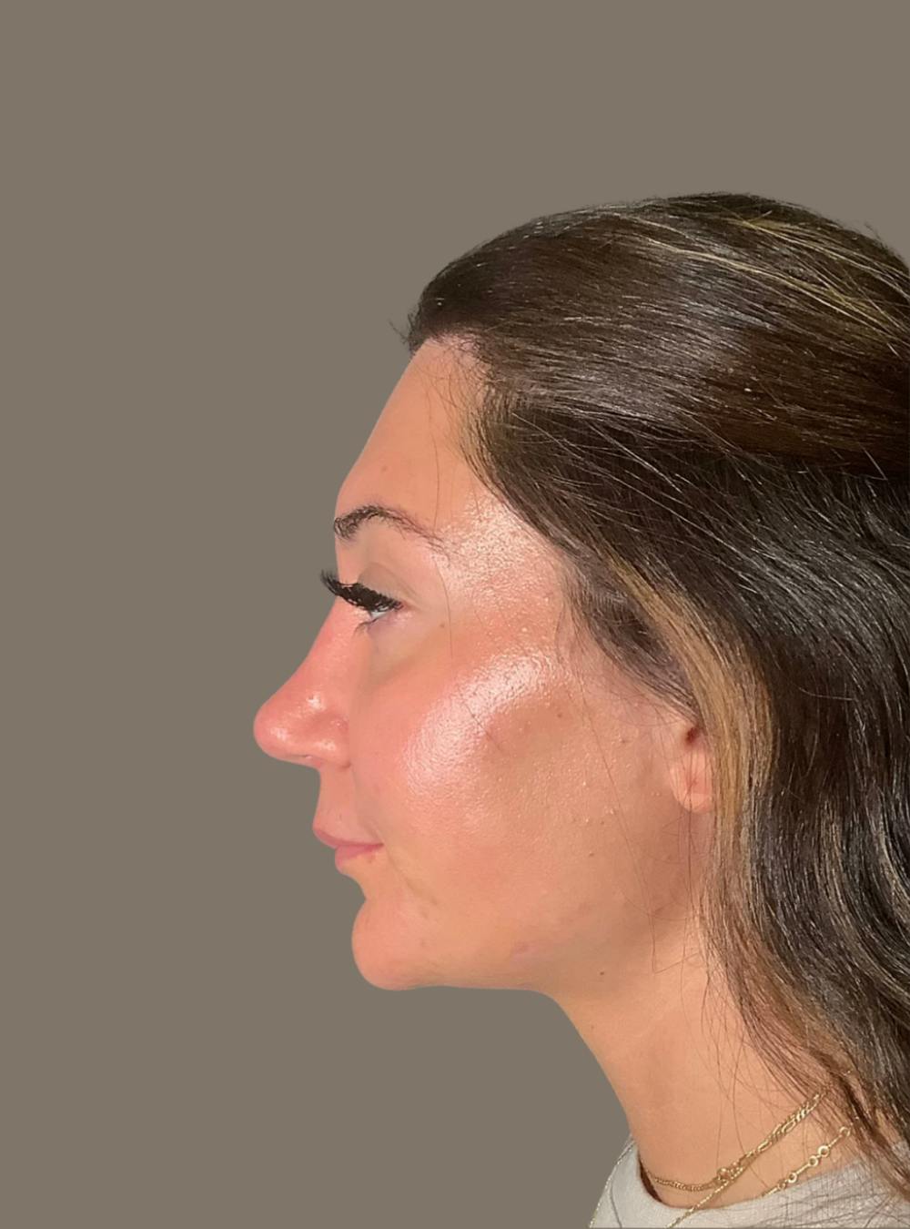 Rhinoplasty Before & After Gallery - Patient 140797 - Image 8