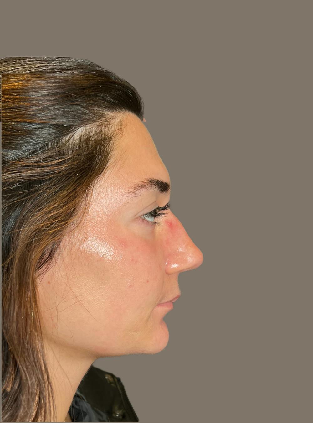 Rhinoplasty Before & After Gallery - Patient 140797 - Image 1