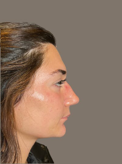 Rhinoplasty Before & After Gallery - Patient 140797 - Image 1