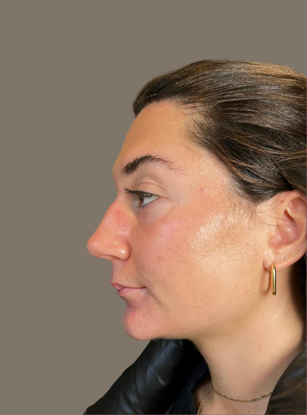 Rhinoplasty Before & After Gallery - Patient 140797 - Image 7