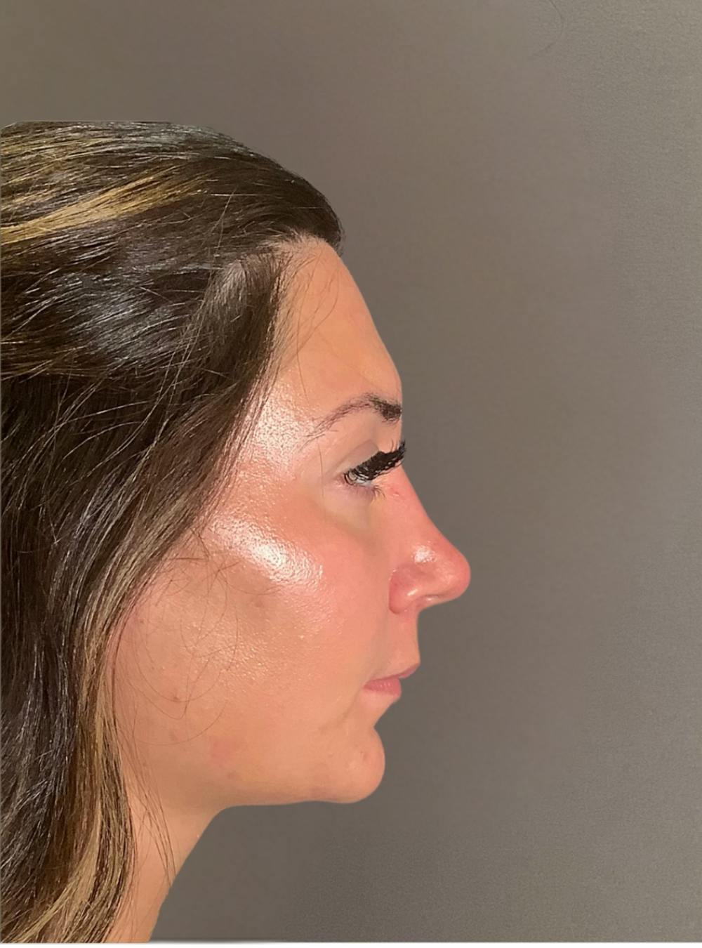 Rhinoplasty Before & After Gallery - Patient 140797 - Image 2