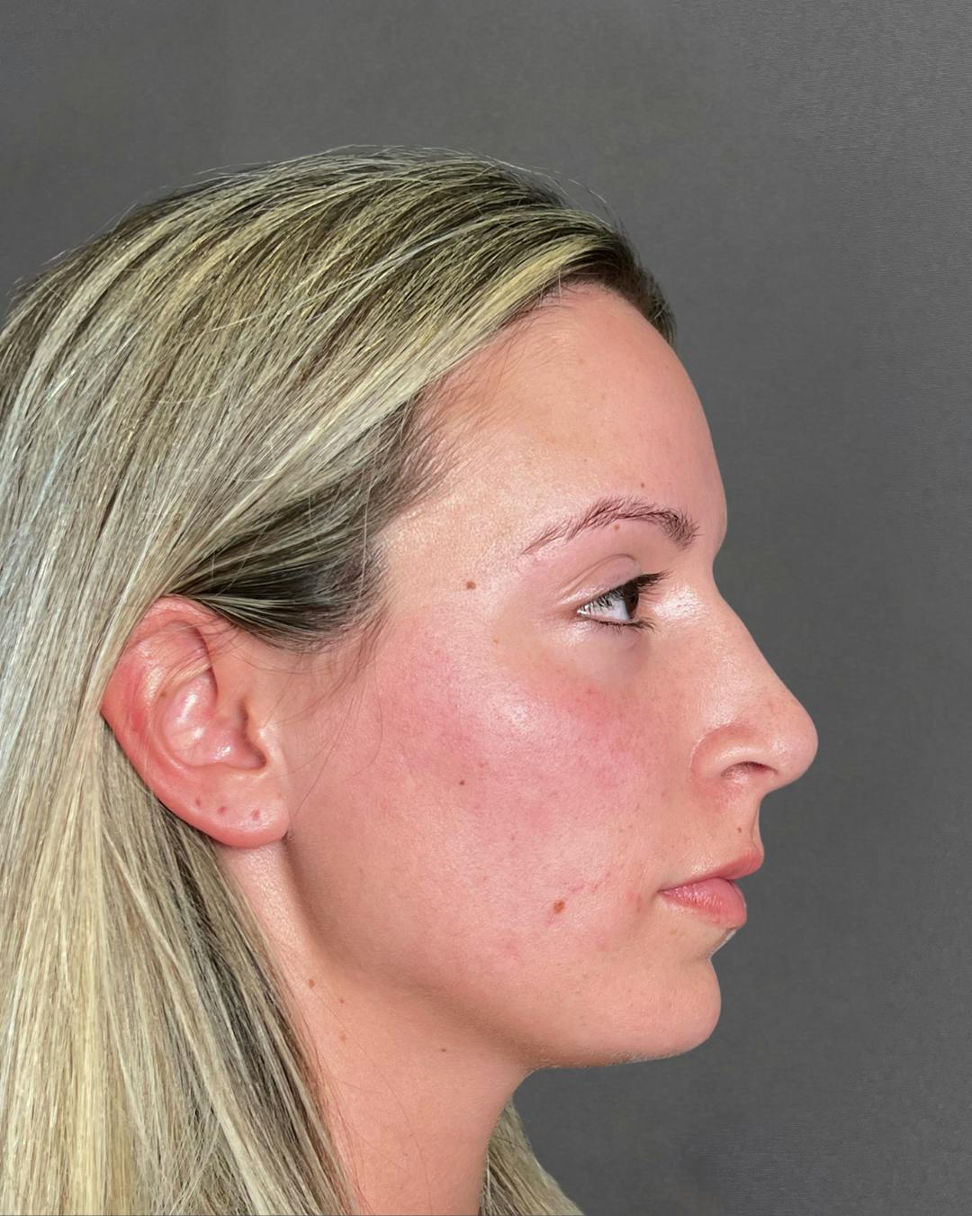 Rhinoplasty Before & After Gallery - Patient 191294117 - Image 1