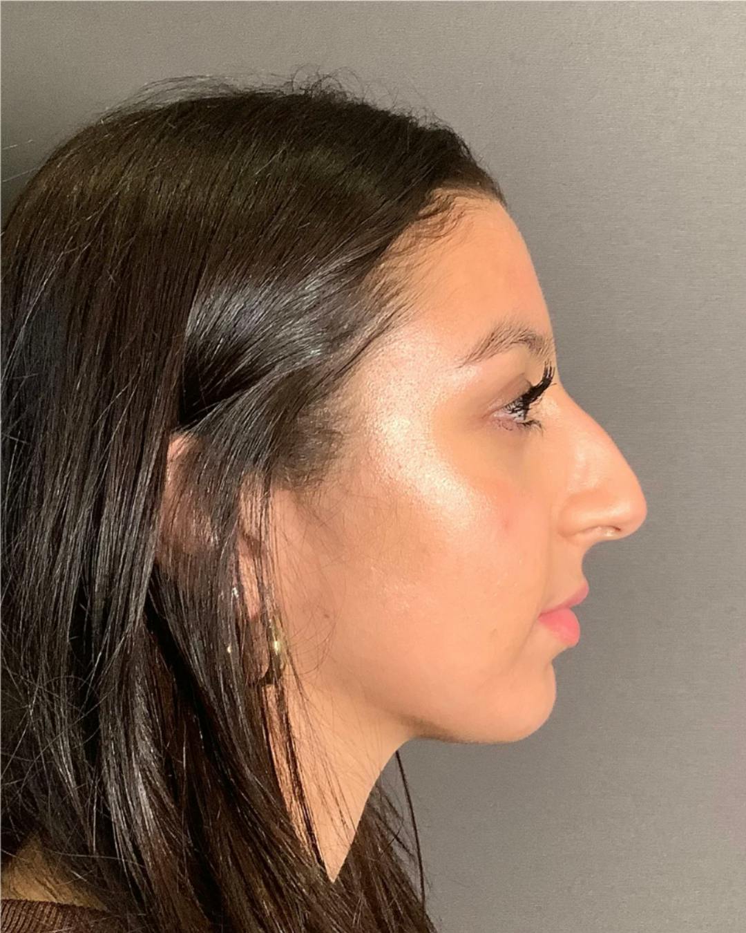Rhinoplasty Before & After Gallery - Patient 393874 - Image 1