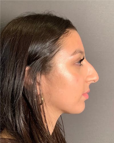 Rhinoplasty Before & After Gallery - Patient 393874 - Image 1