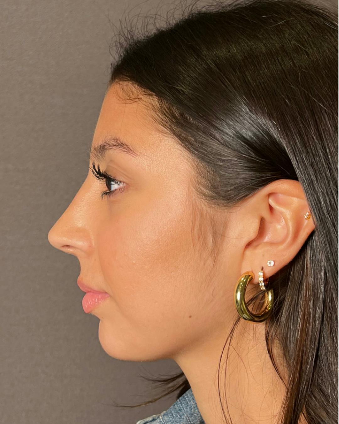 Rhinoplasty Before & After Gallery - Patient 393874 - Image 10