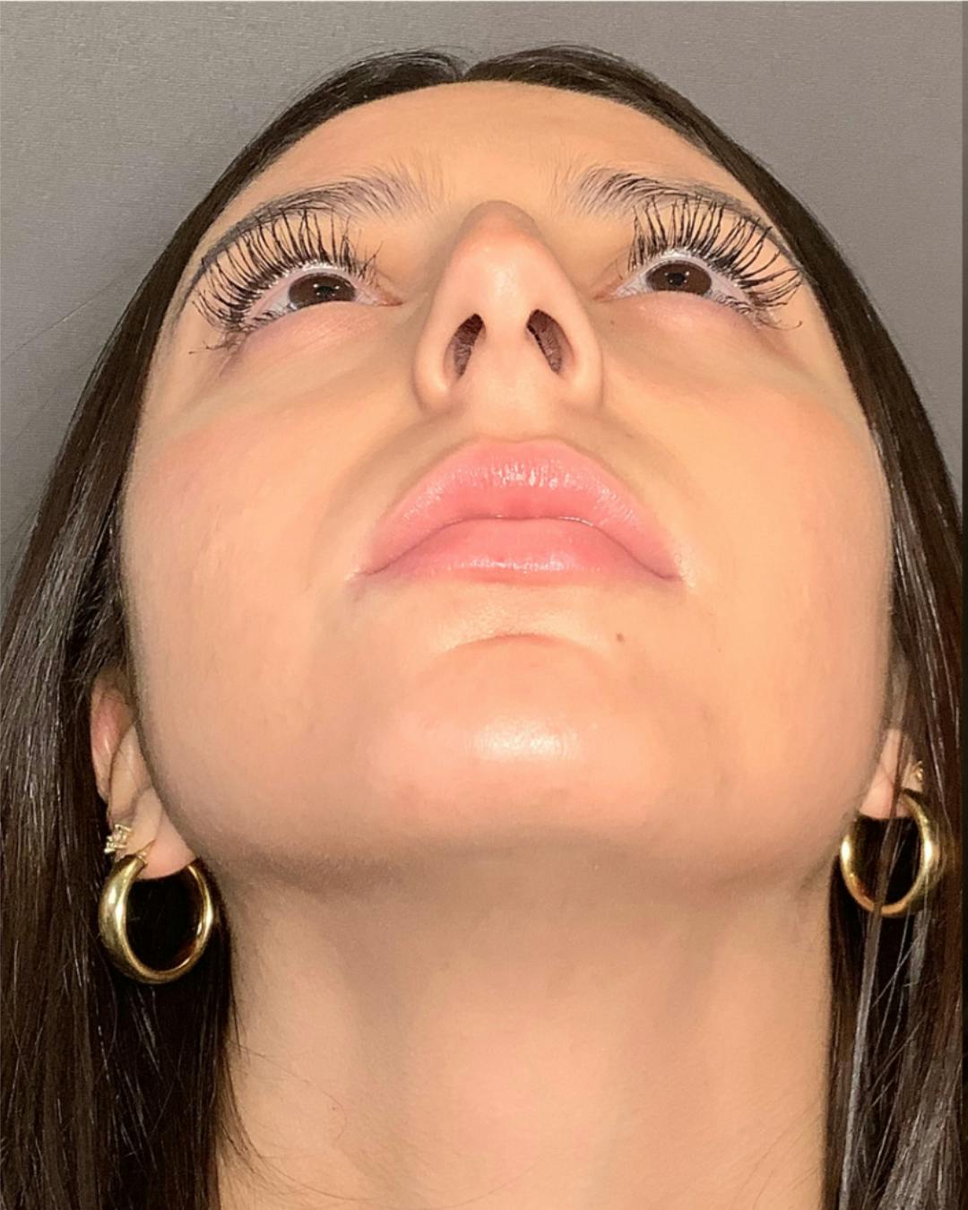 Rhinoplasty Before & After Gallery - Patient 393874 - Image 11