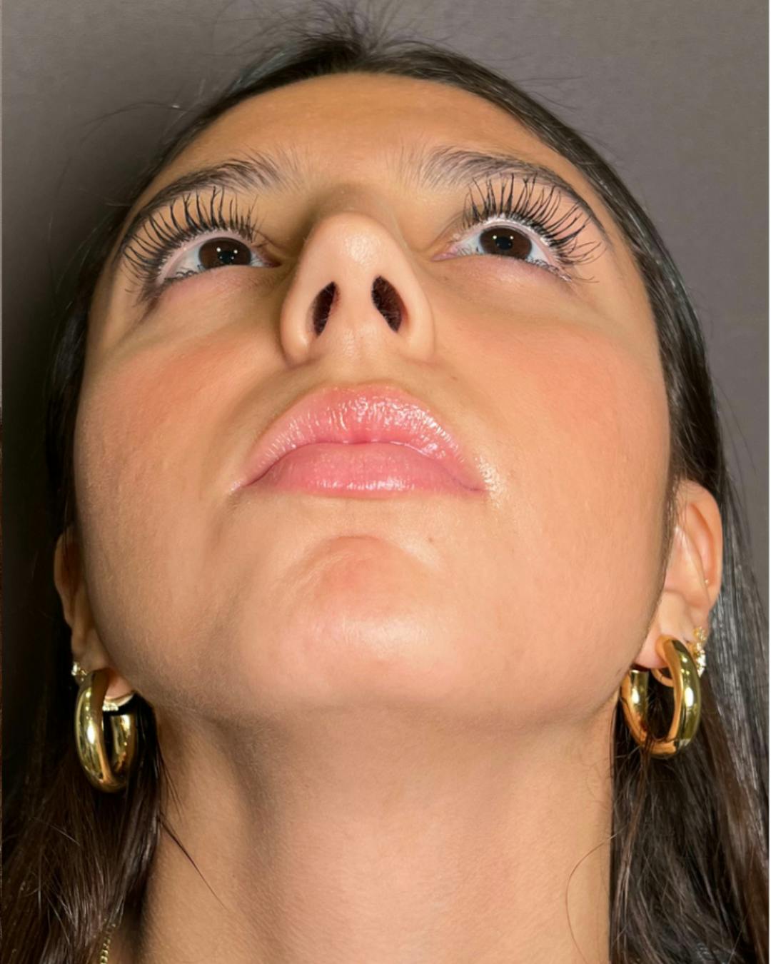 Rhinoplasty Before & After Gallery - Patient 393874 - Image 12