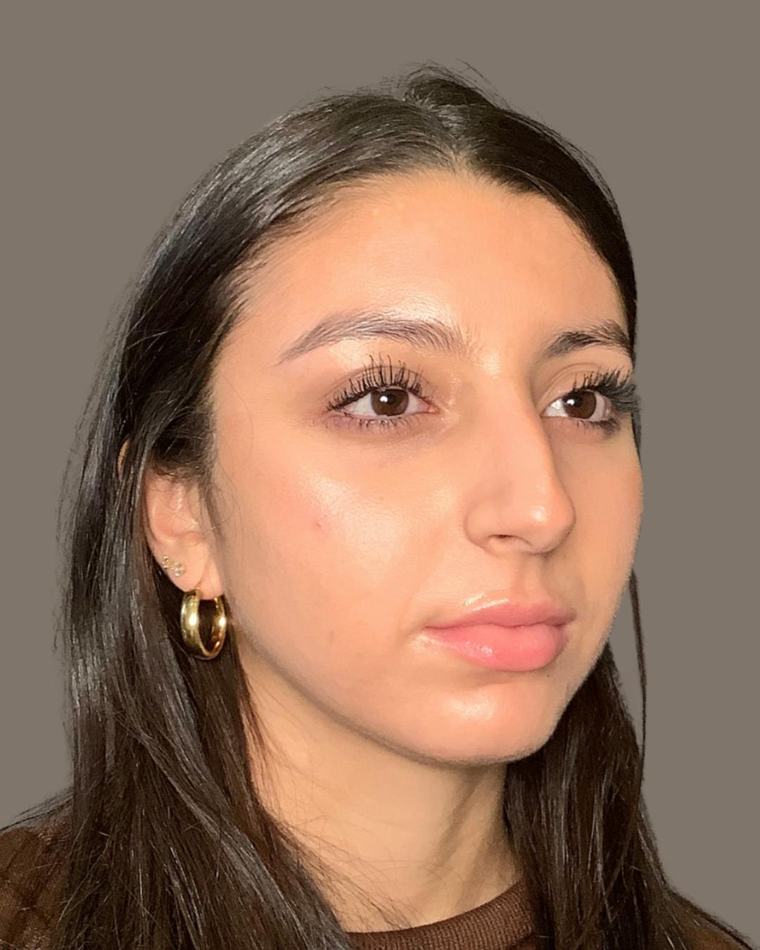 Rhinoplasty Before & After Gallery - Patient 393874 - Image 3