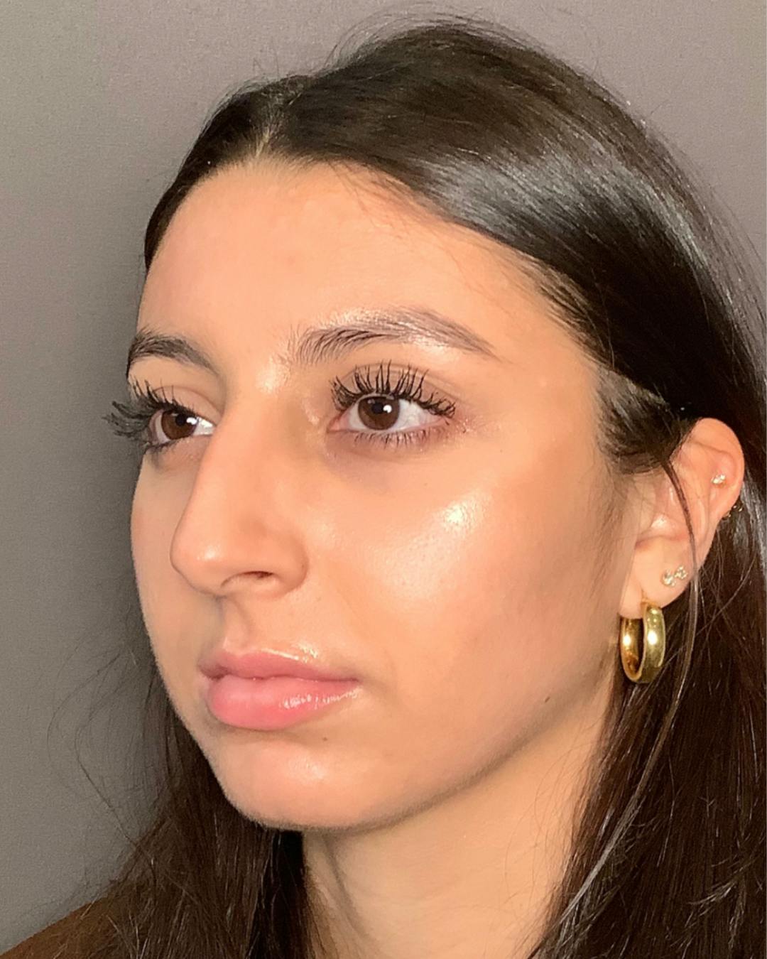 Rhinoplasty Before & After Gallery - Patient 393874 - Image 7