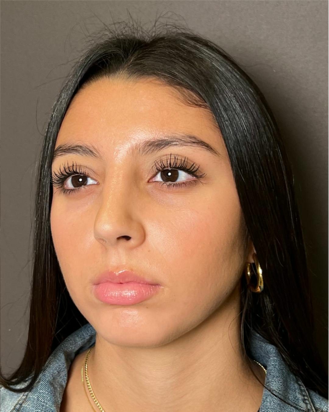 Rhinoplasty Before & After Gallery - Patient 393874 - Image 8