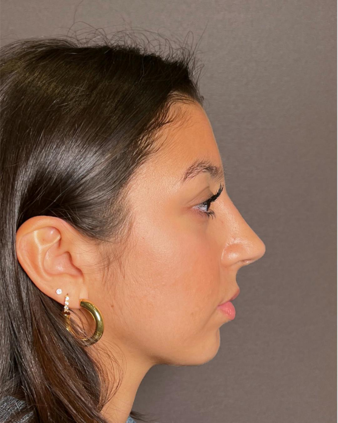 Rhinoplasty Before & After Gallery - Patient 393874 - Image 2