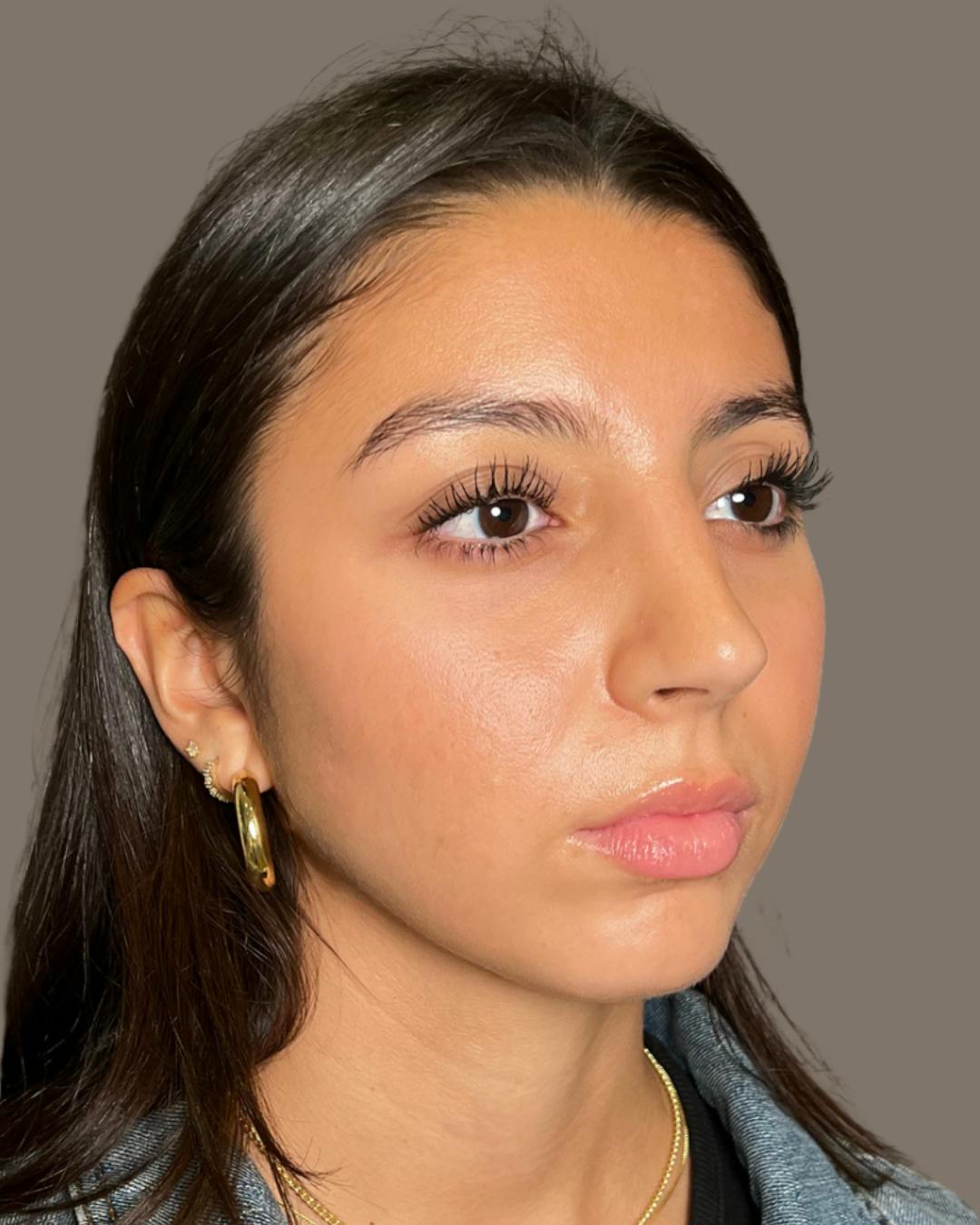 Rhinoplasty Before & After Gallery - Patient 393874 - Image 4