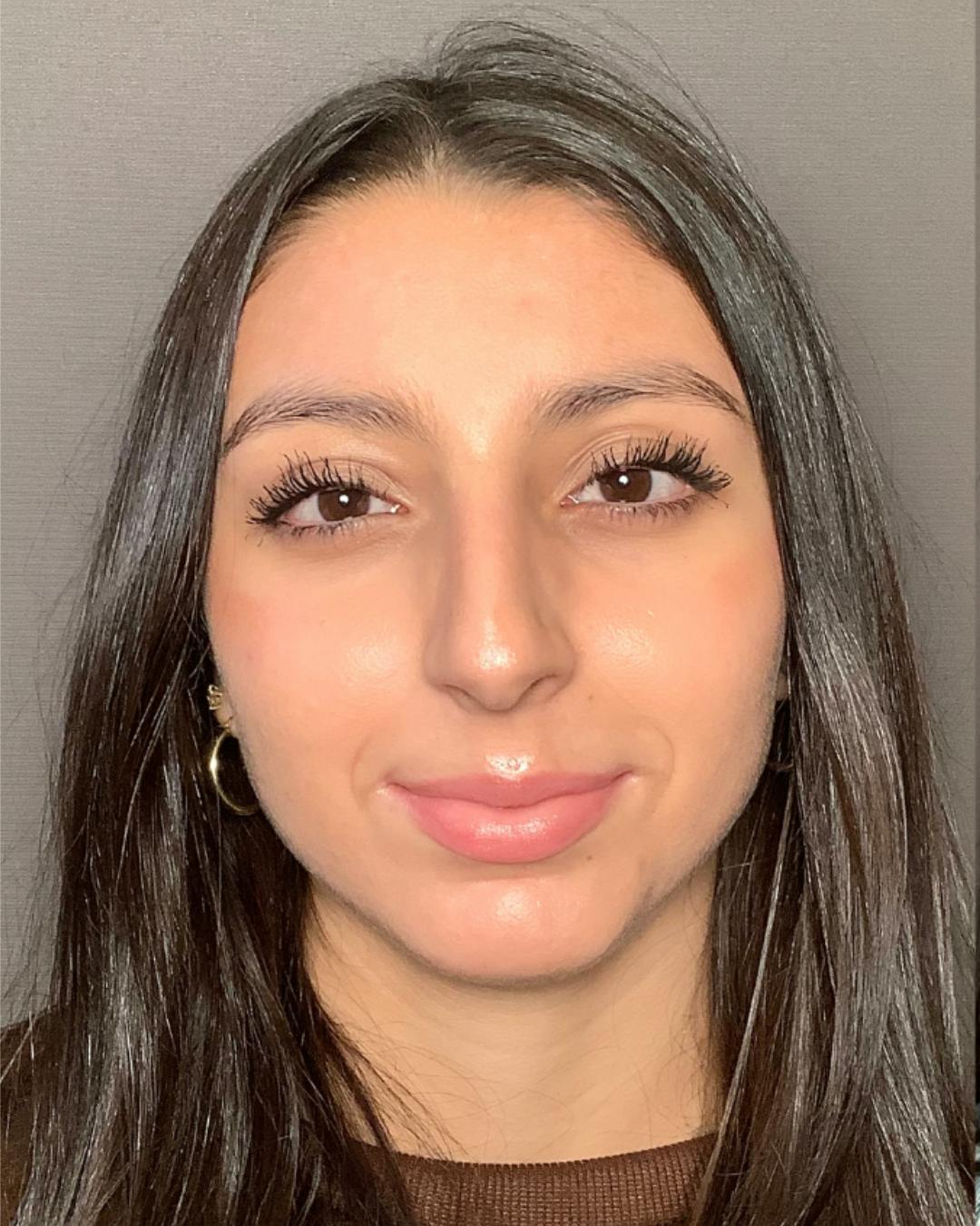 Rhinoplasty Before & After Gallery - Patient 393874 - Image 5