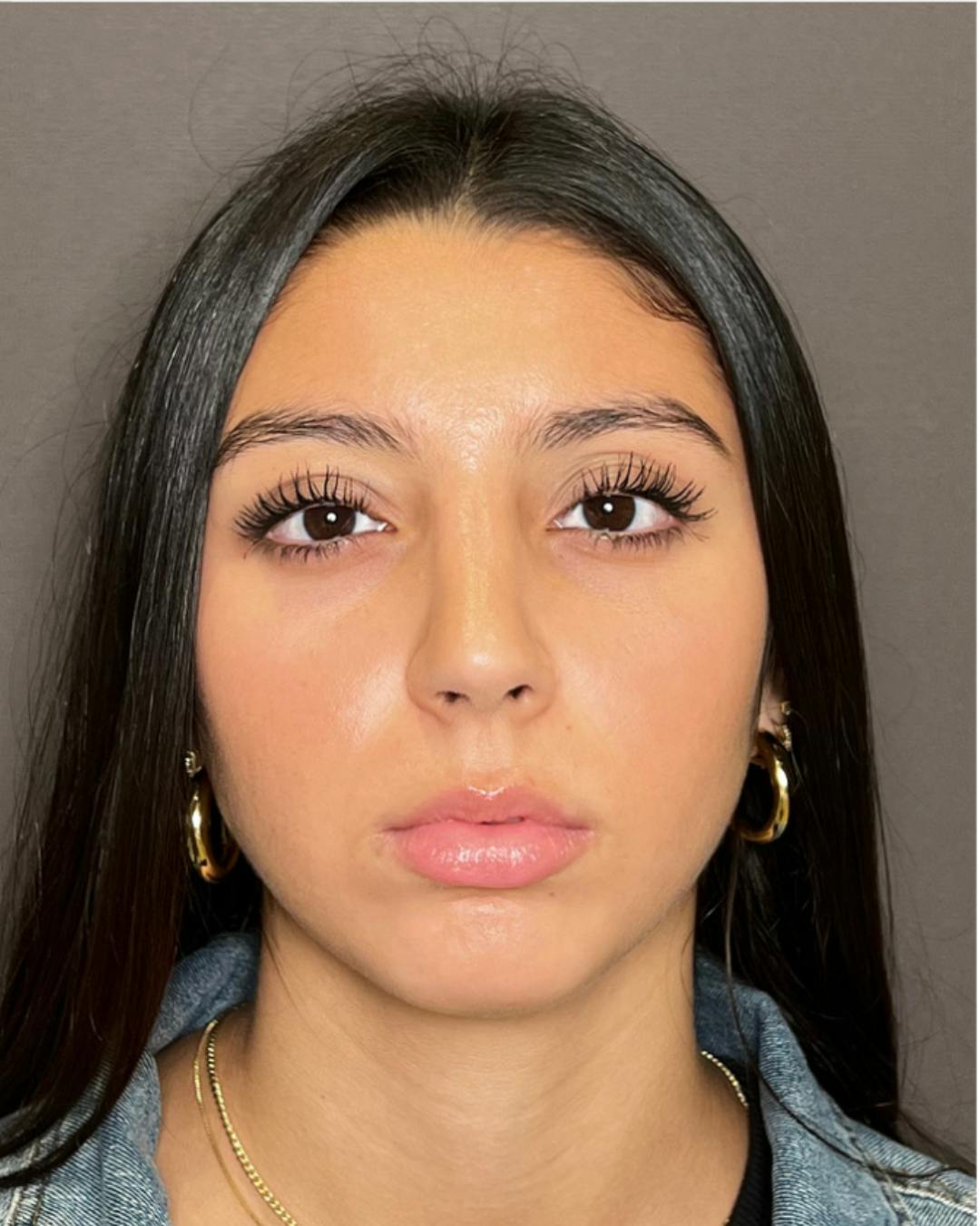 Rhinoplasty Before & After Gallery - Patient 393874 - Image 6