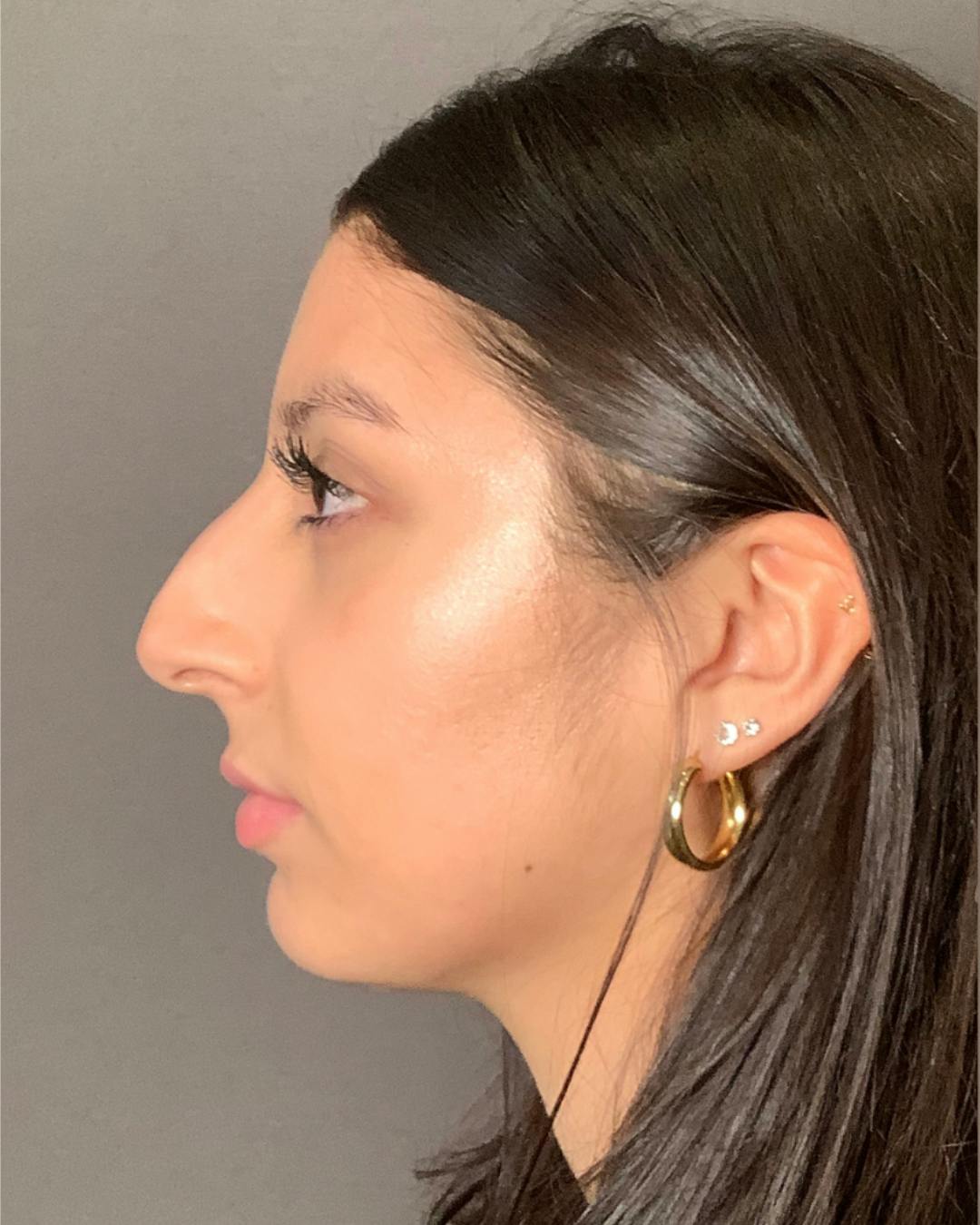 Rhinoplasty Before & After Gallery - Patient 393874 - Image 9