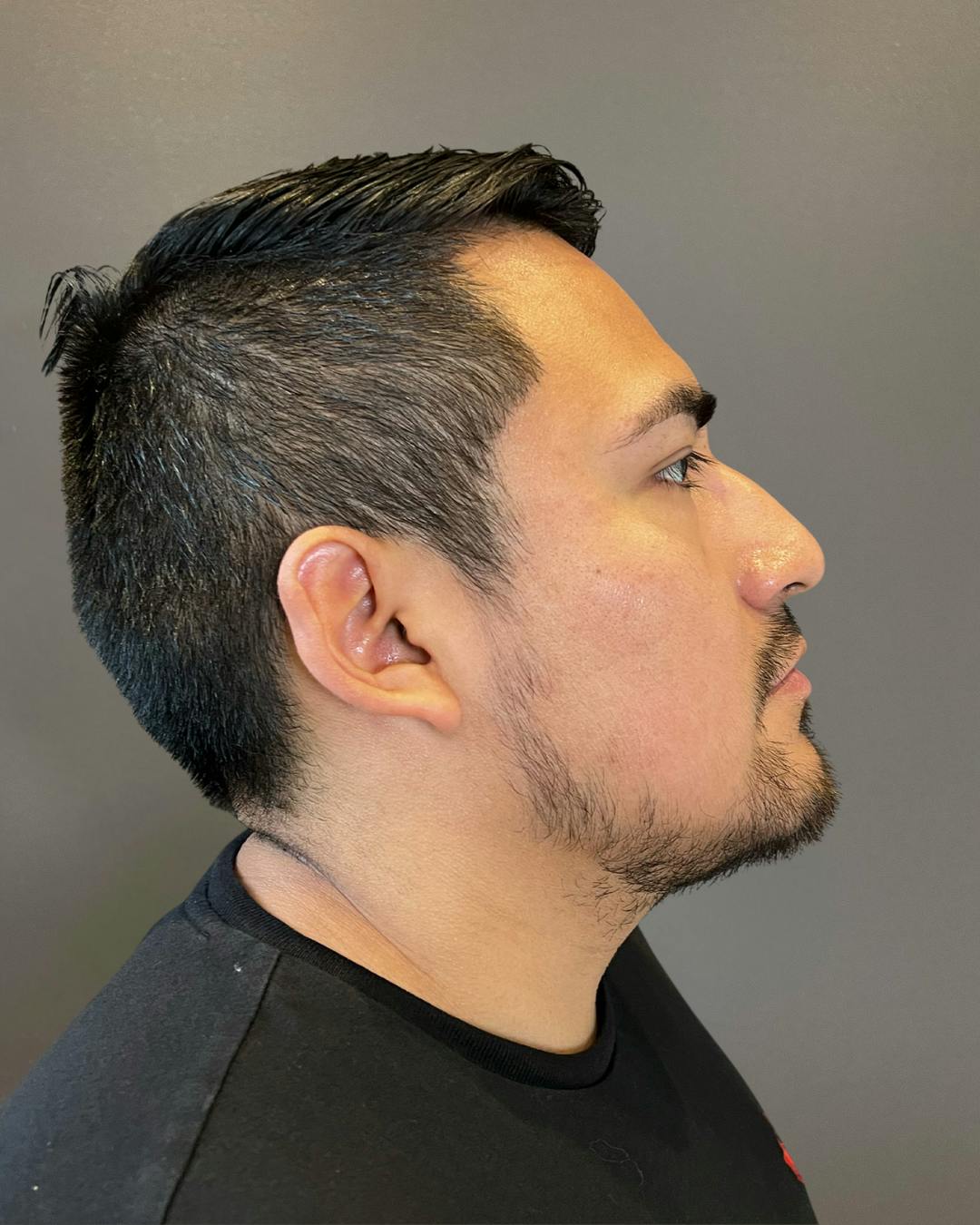 Rhinoplasty Before & After Gallery - Patient 151510777 - Image 1