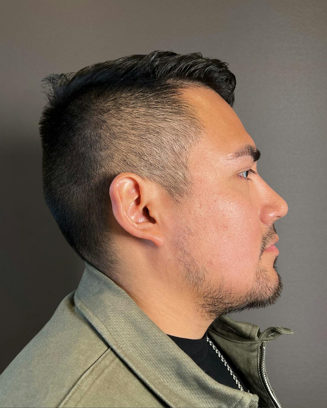 Rhinoplasty Before & After Gallery - Patient 151510777 - Image 2