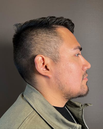 Rhinoplasty Before & After Gallery - Patient 151510777 - Image 2