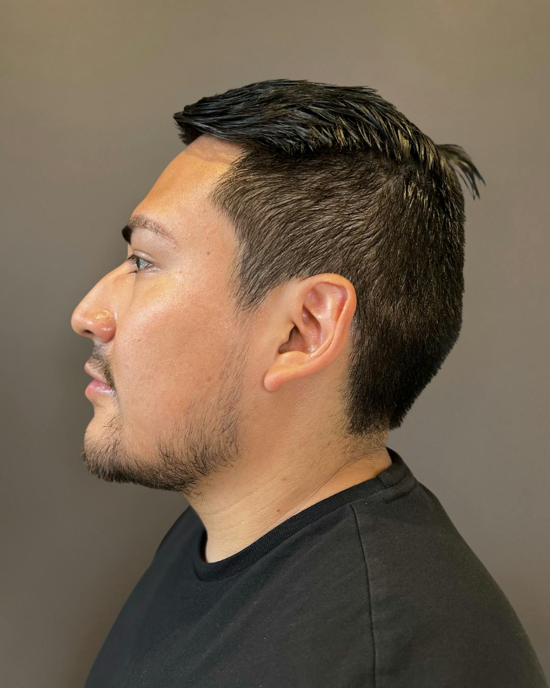 Rhinoplasty Before & After Gallery - Patient 151510777 - Image 7