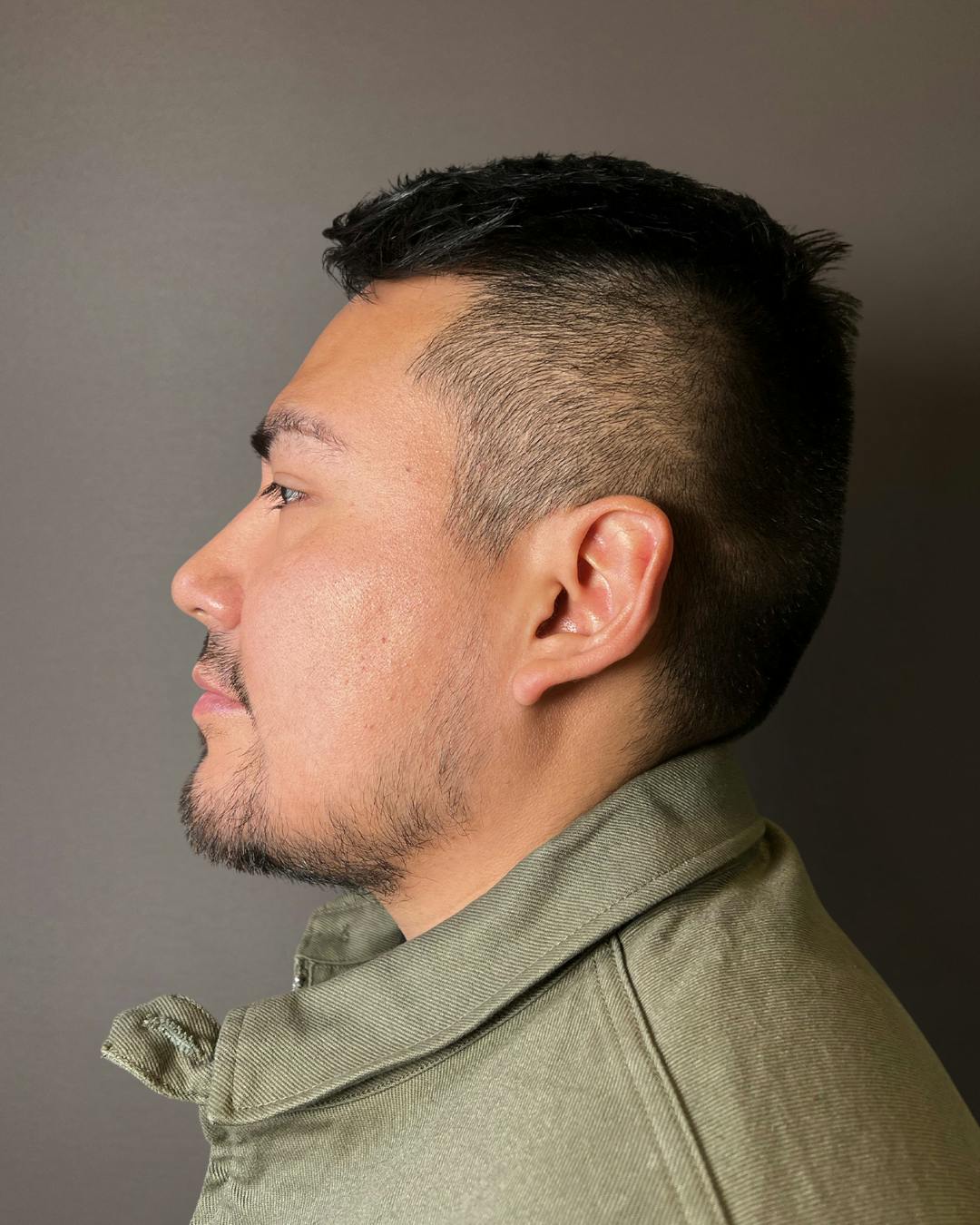 Rhinoplasty Before & After Gallery - Patient 151510777 - Image 8