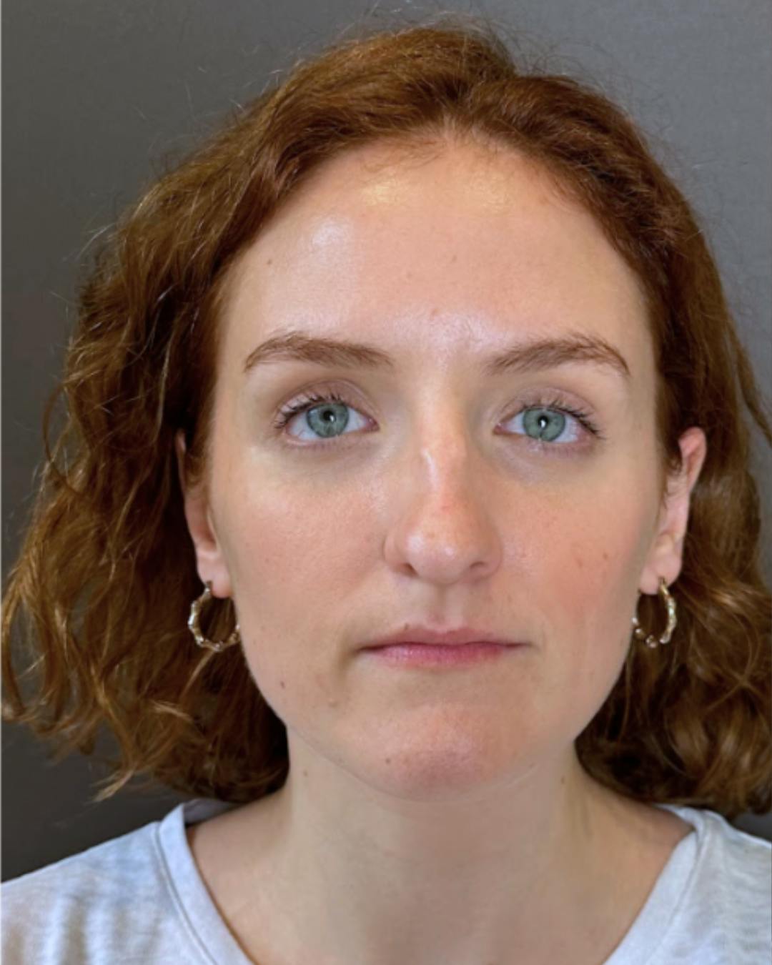Rhinoplasty Before & After Gallery - Patient 352072 - Image 3