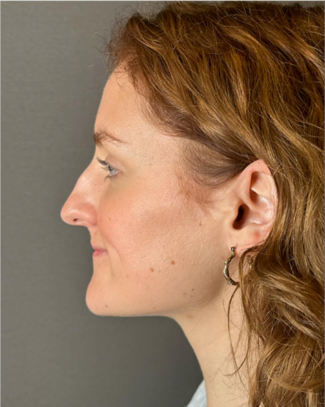 Rhinoplasty Before & After Gallery - Patient 352072 - Image 5