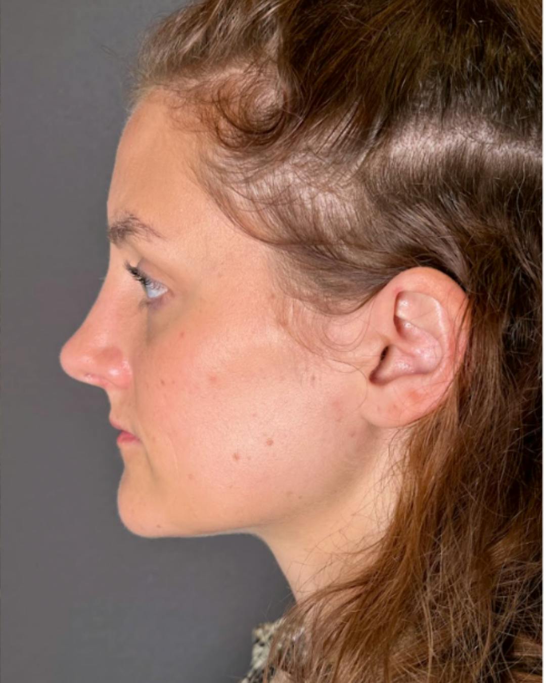 Rhinoplasty Before & After Gallery - Patient 352072 - Image 6