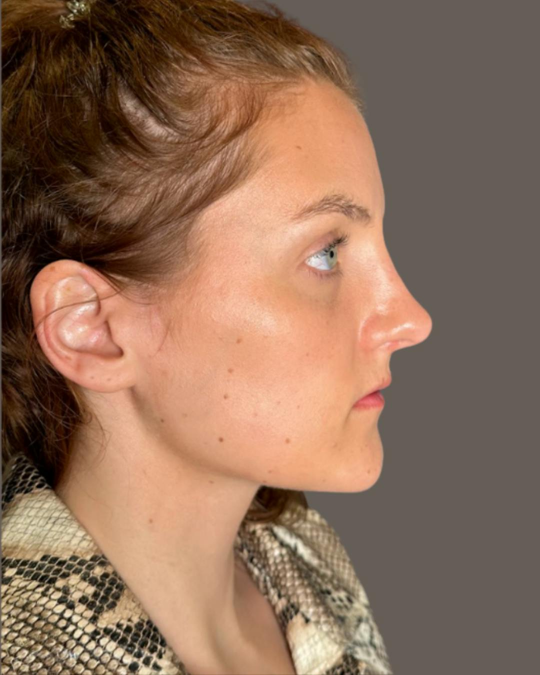 Rhinoplasty Before & After Gallery - Patient 352072 - Image 2