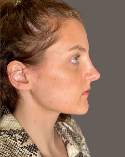 Rhinoplasty Before & After Gallery - Patient 352072 - Image 2